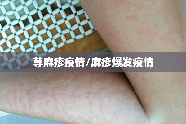 荨麻疹疫情/麻疹爆发疫情 荨麻疹疫情/麻疹爆发疫情