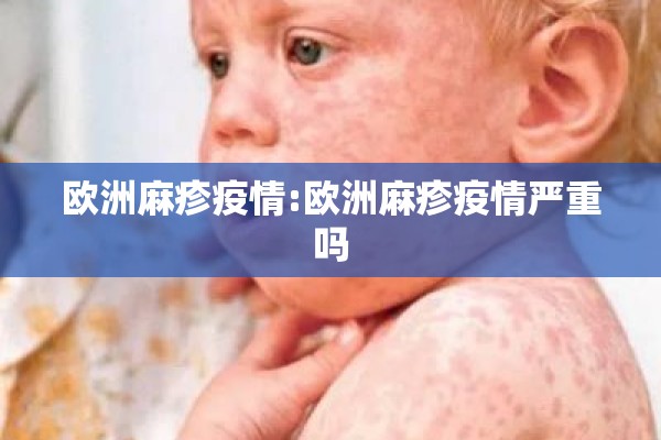 欧洲麻疹疫情:欧洲麻疹疫情严重吗 欧洲麻疹疫情:欧洲麻疹疫情严重吗