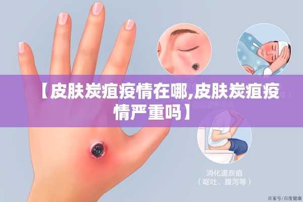 【皮肤炭疽疫情在哪,皮肤炭疽疫情严重吗】
